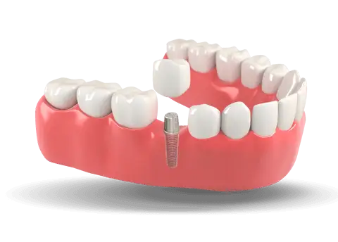 Dental Implants