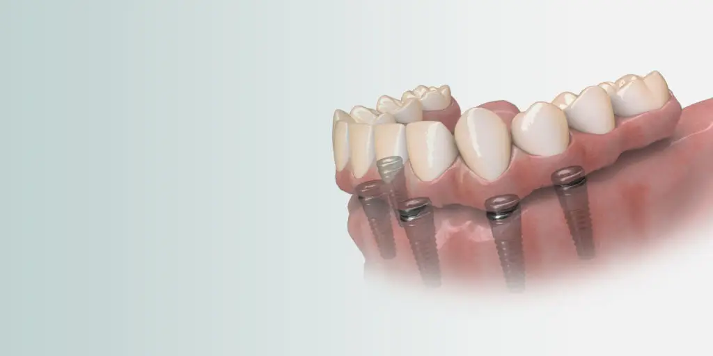 Dental Implants in North Royalton, OH Restore Dental Wellness: Dentists in North Royalton, OH