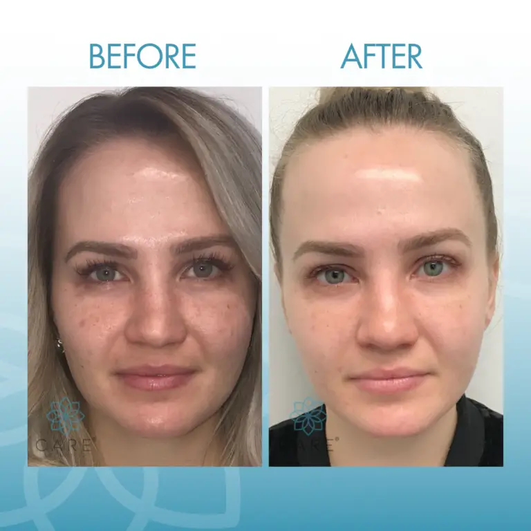 Bio Lift Signature Treatment Results
