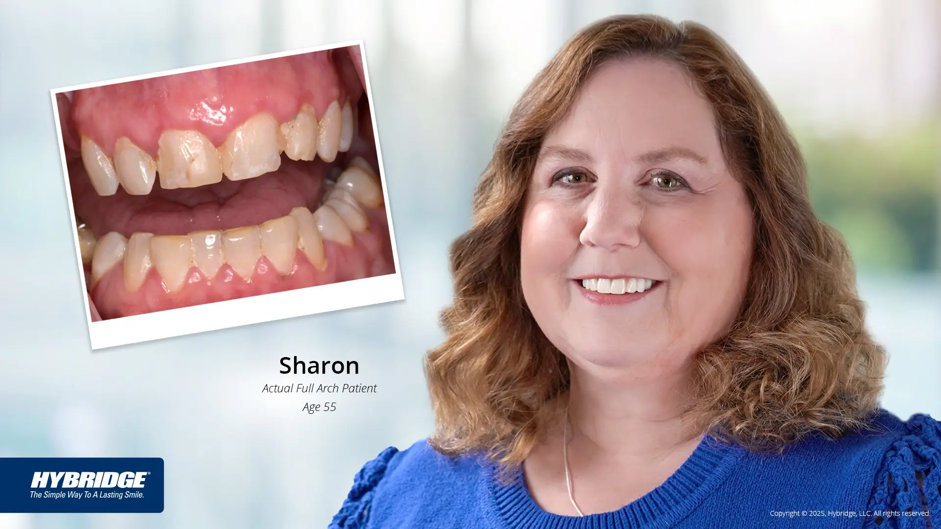 Full Arch Rehabilitation in North Royalton, OH