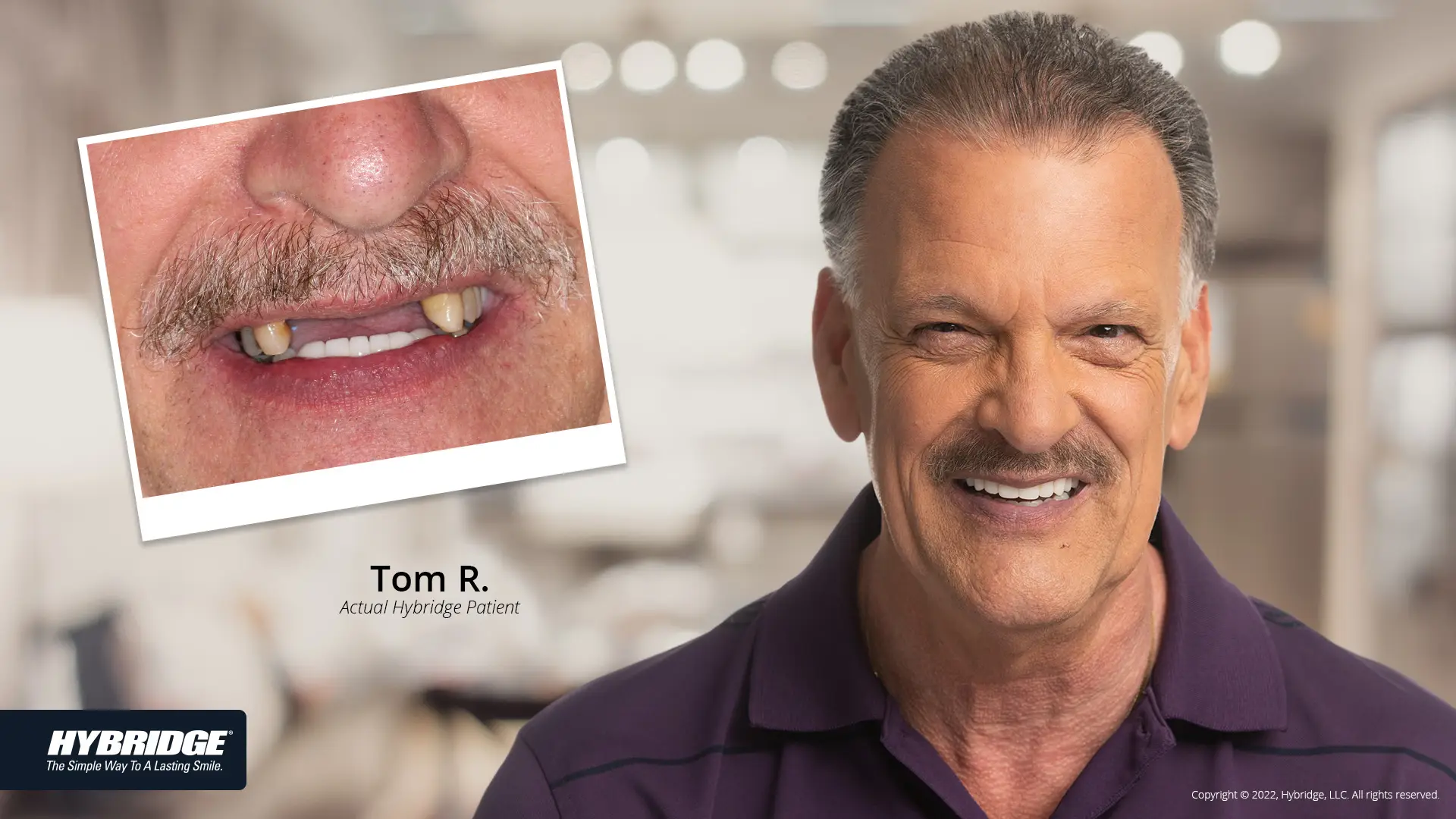 Dental Implants in North Royalton, OH